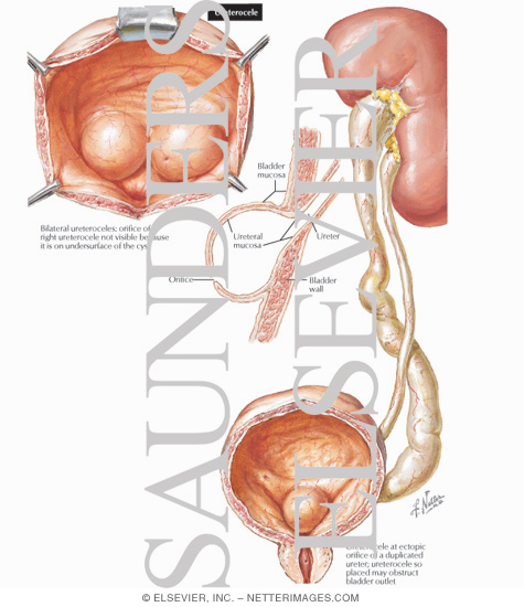 Watermarked preview of labeled image: Ureterocele