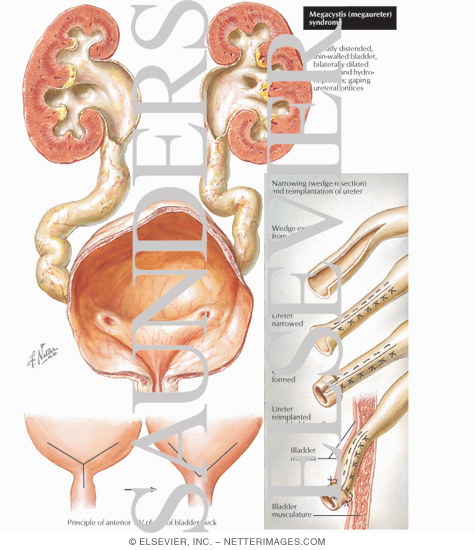 Megacystis (Megaureter) Syndrome