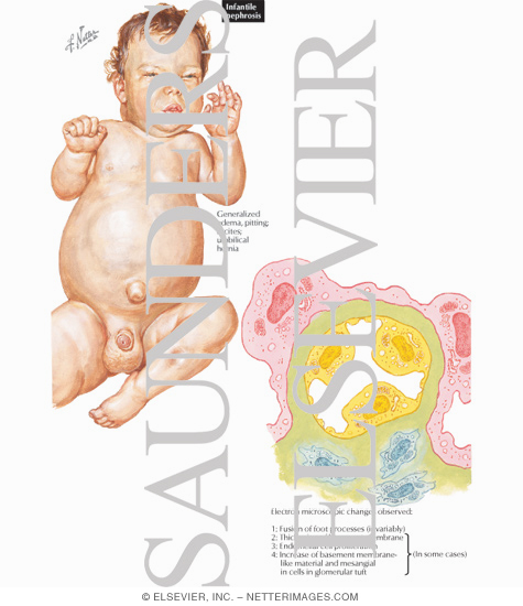 Watermarked preview of labeled image: Infantile Nephrosis
