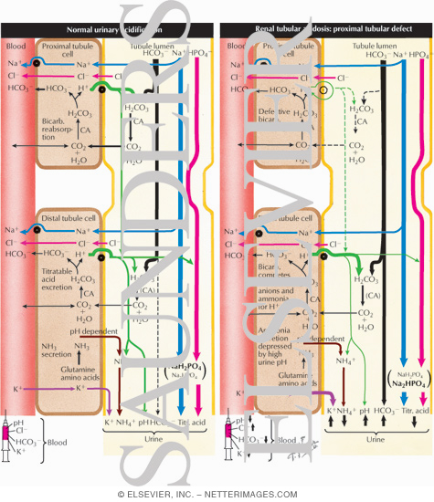 Normal Urinary Acidfication - Renal Tubular Acidosis: Proximal Tubular Defect