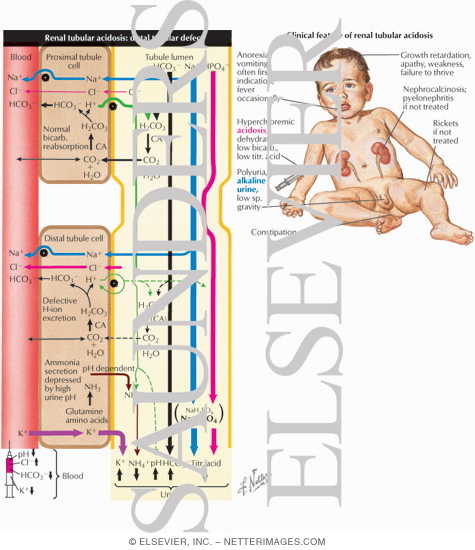 Renal Tubular Acidosis: Distal Tubular Defect