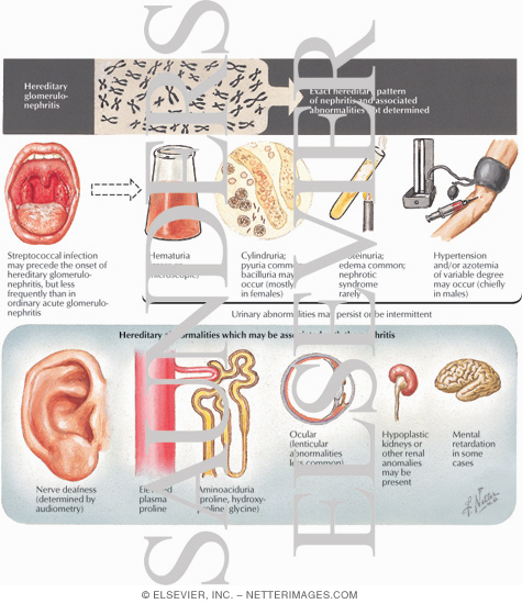 Watermarked preview of labeled image: Hereditary Glomerulonephritis