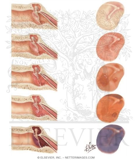 Degrees of Aerotitis Produced By Pressure Differential