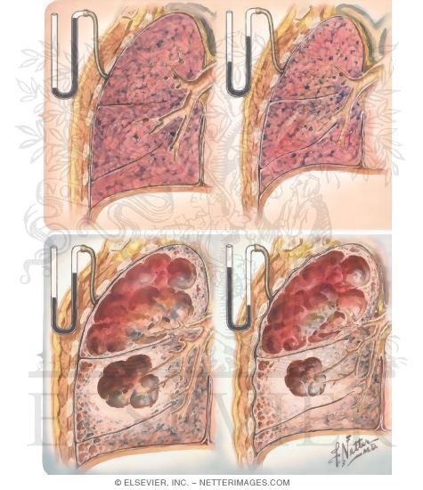 Watermarked preview of unlabeled image: Gross Pathologic Changes In Emphysema