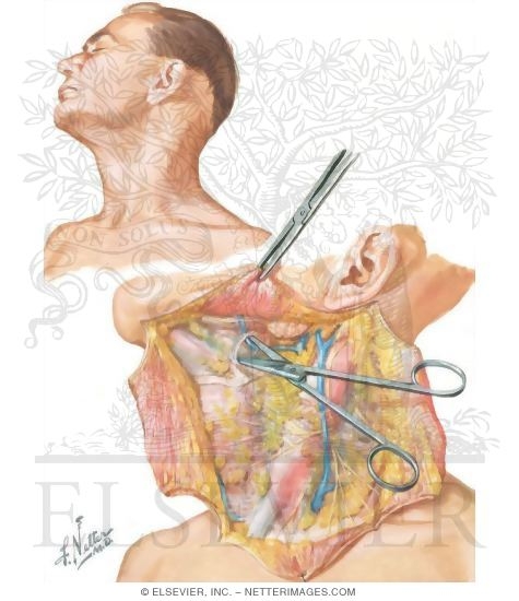 Radical Neck Dissection