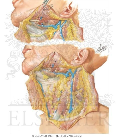 Radical Neck Dissection