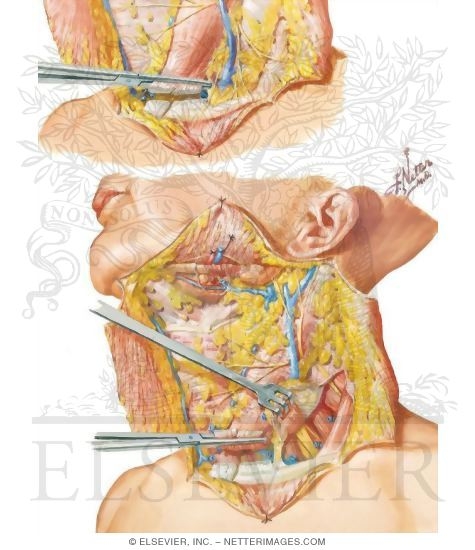 Radical Neck Dissection