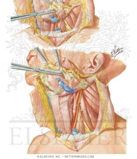 Watermarked preview of unlabeled image: Radical Neck Dissection