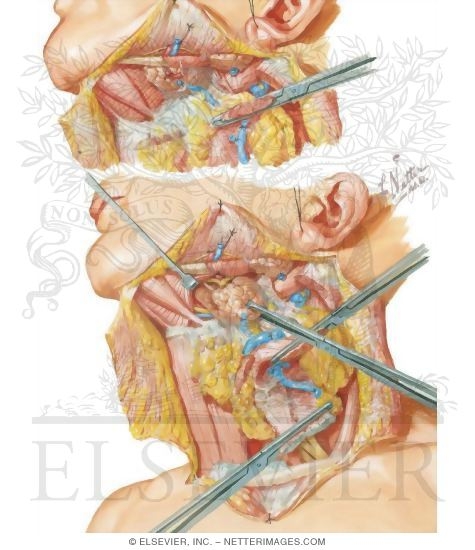 Radical Neck Dissection