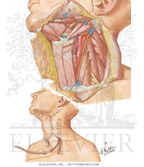 Watermarked preview of unlabeled image: Radical Neck Dissection