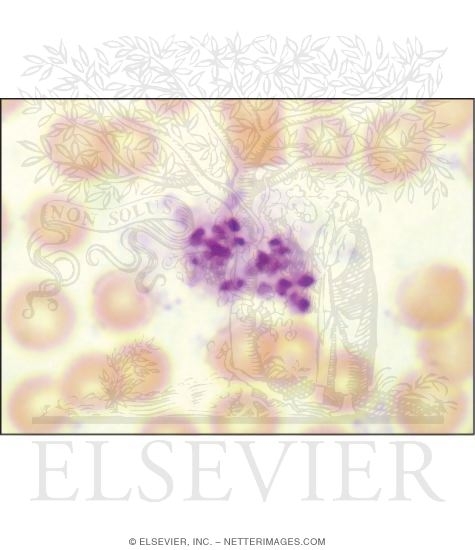 Light Micrograph of a Clump of Platelets In a Blood Smear
