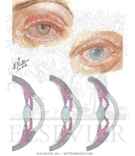 Iritis, Glaucoma