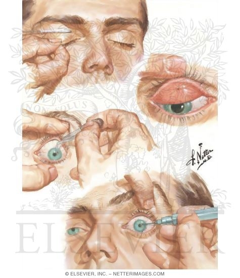 Watermarked preview of unlabeled image: Removal of Foreign Body In the Eye