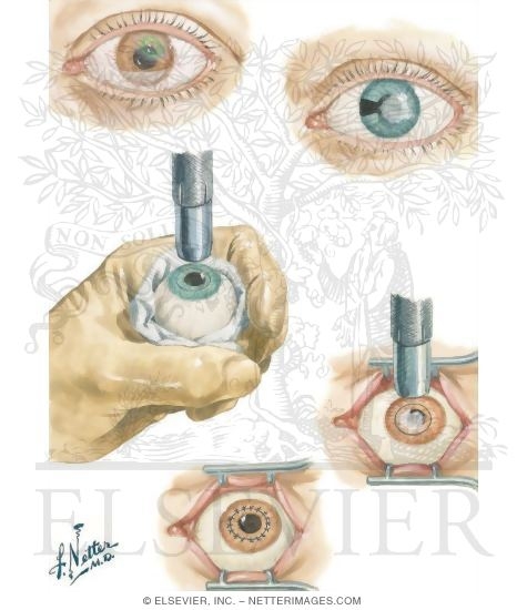 Corneal Ulcer