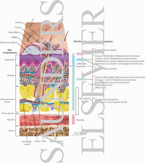 Cross-Section of the Skin Showing Layer and Types of Infections