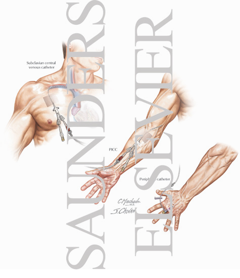 Watermarked preview of labeled image: Catheter Placement