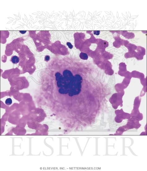 A Bone Marrow Smear Showing a Megakaryocyte