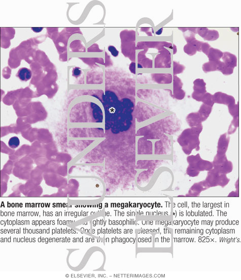 A Bone Marrow Smear Showing a Megakaryocyte