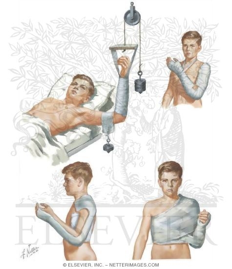 Supracondylar Fracture