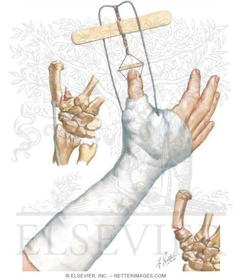 Watermarked preview of unlabeled image: Fracture of First Metacarpal