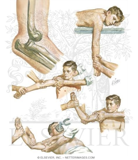 Watermarked preview of unlabeled image: Posterior Dislocation of the Elbow