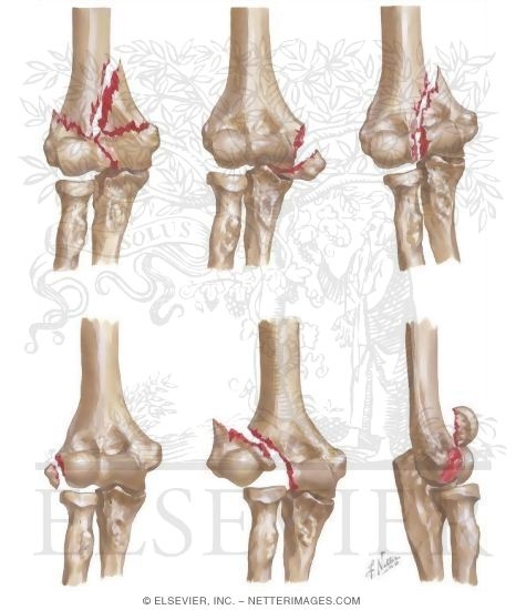 Condylar Fractures of the Humerus