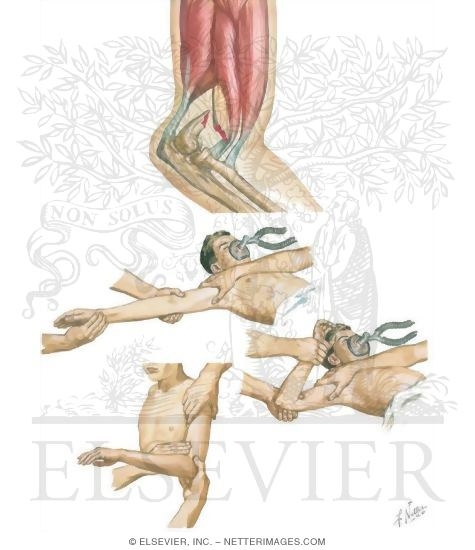 Watermarked preview of unlabeled image: Supracondylar Fracture