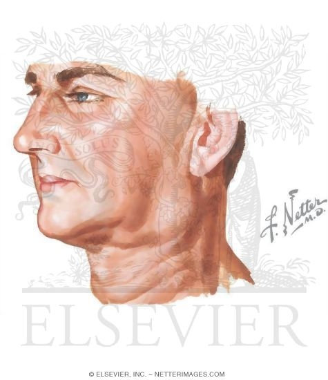 Watermarked preview of unlabeled image: Enlarged Cervical Lymph Node In the Neck