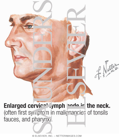 Enlarged Cervical Lymph Node In the Neck