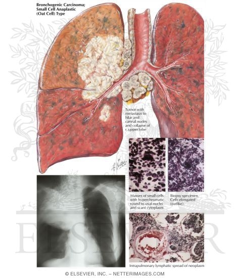 Bronchogenic Carcinoma: Small Cell Anaplastic (Oat Cell) Type