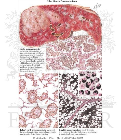 Other Mineral Pneumoconioses