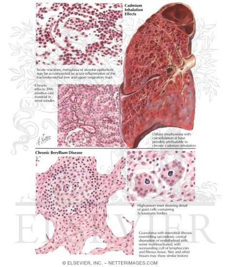 Cadmium Inhalation Effects - Chronic Beryllium Disease