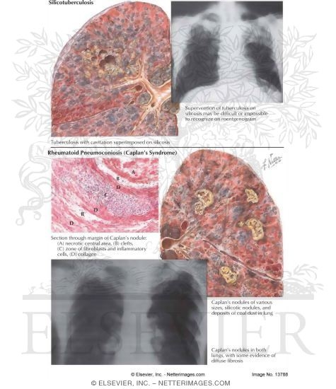 Watermarked preview of labeled image: Silicotuberculosis