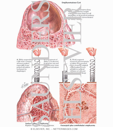 Emphysematous Cyst