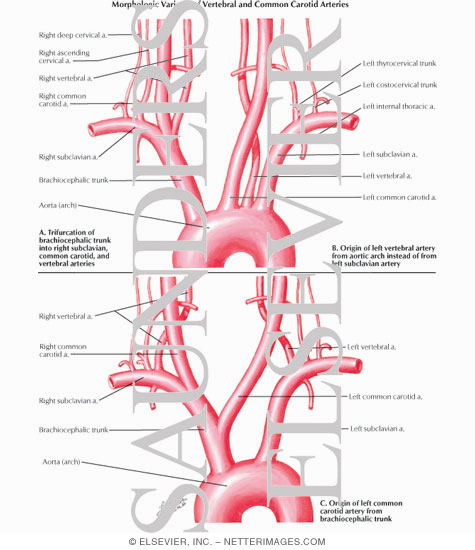 Morphologic Variants of Vertebral and Common Carotid Arteries