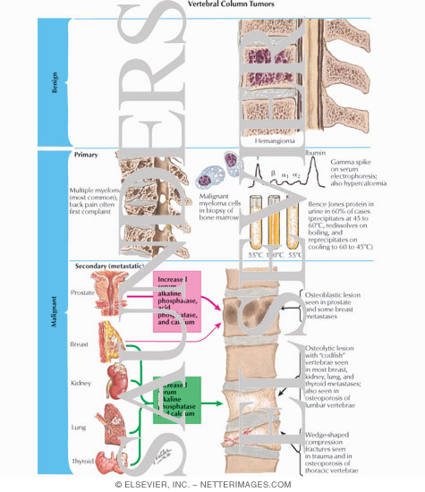Vertebral Column Tumors 