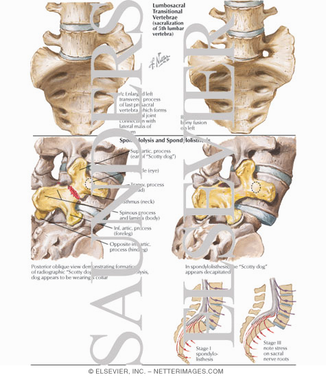 Lumbosacral Transitional Vertebrae; Spondylolysis and Spondylolisthesis