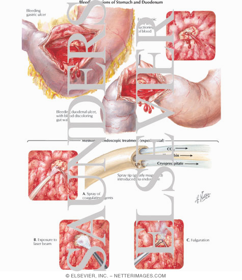 Watermarked preview of labeled image: Bleeding Lesions of Stomach and Duodenum