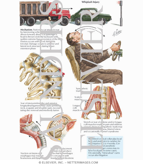 Watermarked preview of labeled image: Whiplash Injury