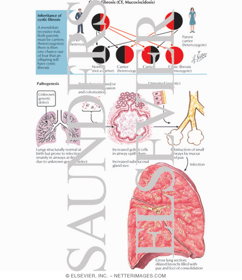 Watermarked preview of labeled image: Cystic Fibrosis (CF, Mucoviscidosis)