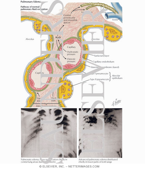 Watermarked preview of labeled image: Pulmonary Edema