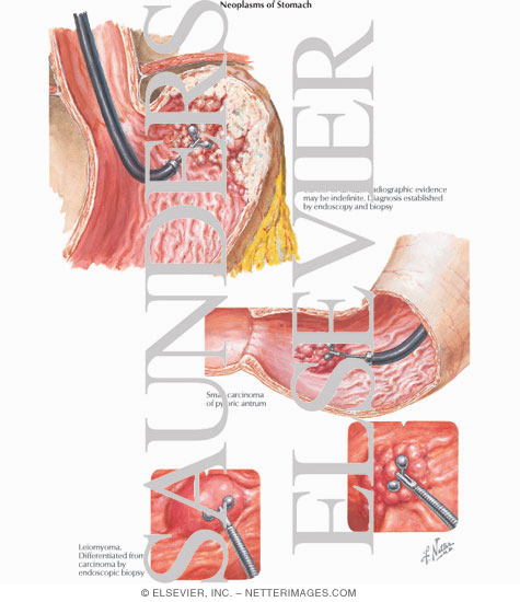 Watermarked preview of labeled image: Neoplasms of Stomach