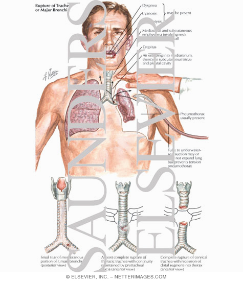 Rupture of Trachea or Major Bronchi