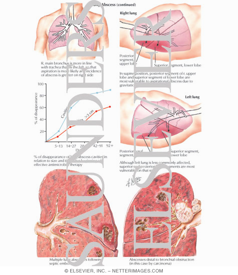 Lung Abscess