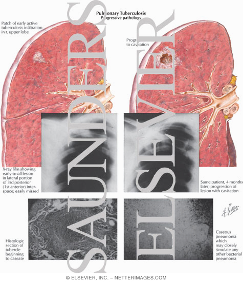 Watermarked preview of labeled image: Pulmonary Tuberculosis - Progressive Pathology