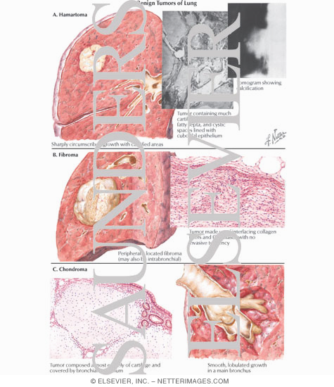 Benign Tumors of Lung