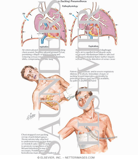 Watermarked preview of labeled image: Open (Sucking) Pneumothorax