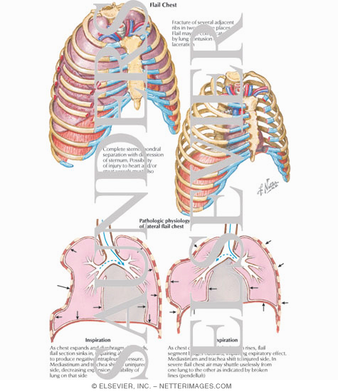 Watermarked preview of labeled image: Flail Chest