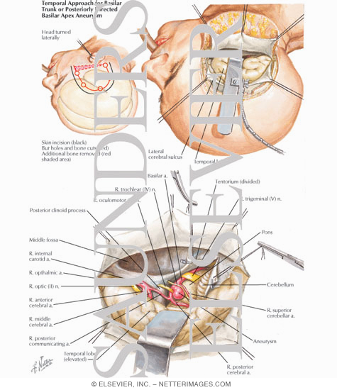 Temporal Approach for Basilar Trunk or Posteriorly Directed Basilar Apex Aneurysm