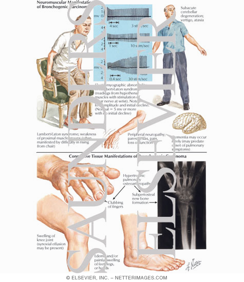 Watermarked preview of labeled image: Neuromuscular Manifestations of Bronchogenic Carcinoma - Connective Tissue Manifestations of Bronchogenic Carcinoma